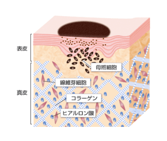 ほくろができる原因